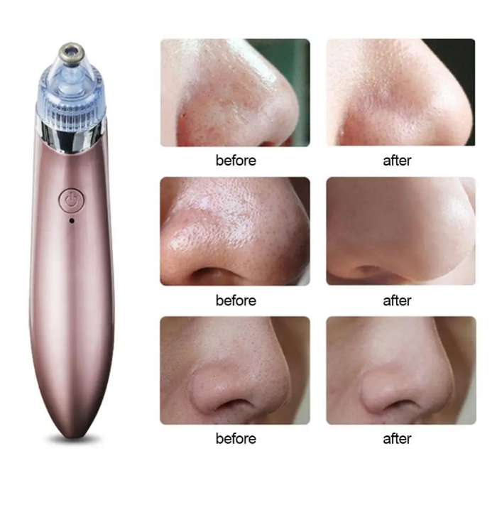 Electric Blackhead Remover™ - Skin Glam Tech™