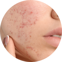 Acne & Blemishes