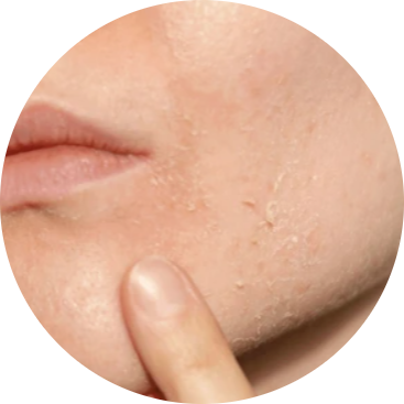 Dryness & Dehydration