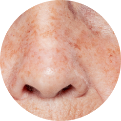 Hyperpigmentation & Dark Spots