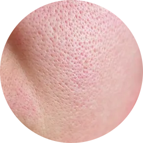 Enlarged Pores & Texture