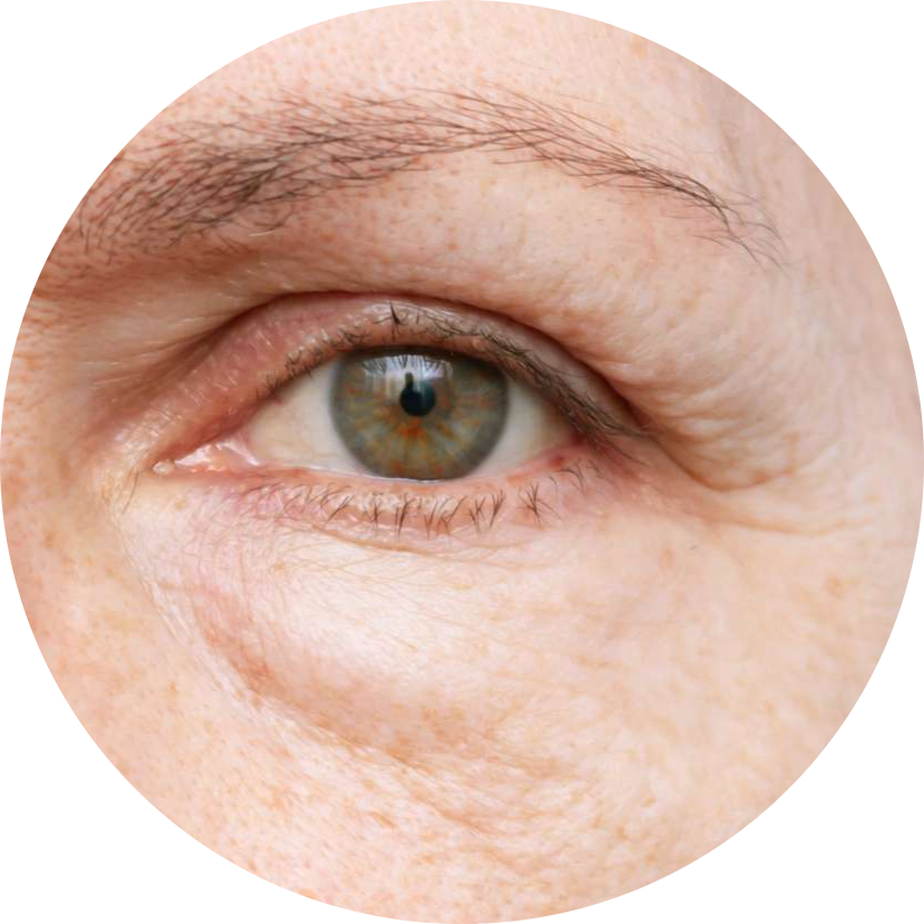 Puffiness & Swelling