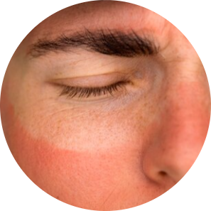 Sun Damage & Dark Spots